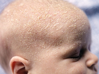 Baby Rash Cradle Cap