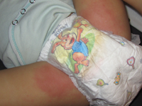 Baby Nappy Rash