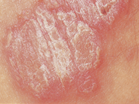 Psoriasis picture